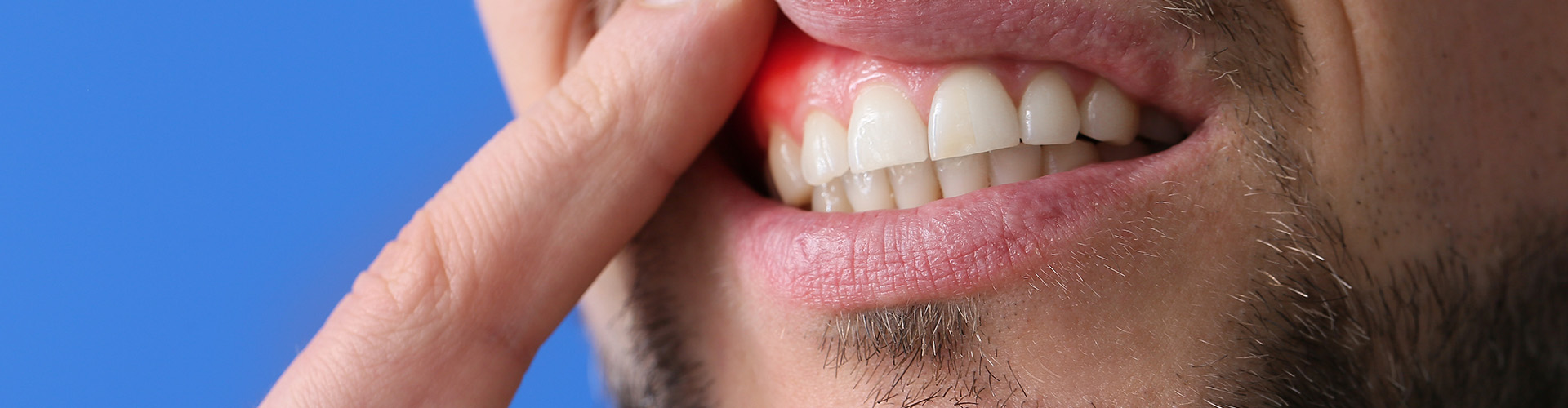 man raising lip to show inflamed gums